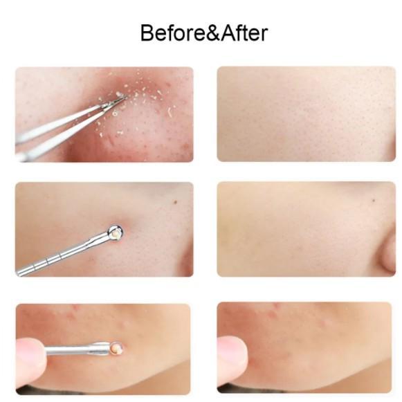 Blackhead Remover Comedone Blemish Acne Pimple Extractor Tool 202